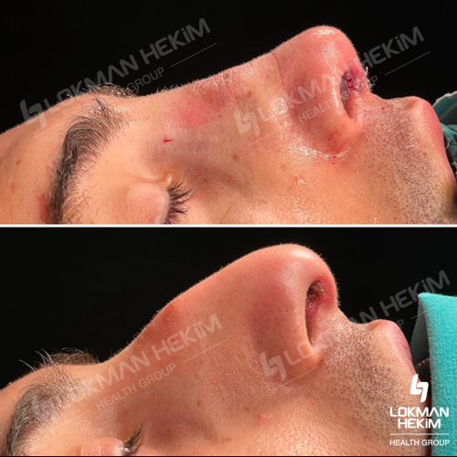 رأب و تجميل الحاجز الأنفي صور قبل وبعد